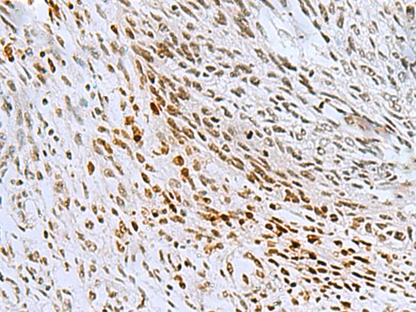 CNOT7 Antibody - Immunohistochemistry of paraffin-embedded Human lung cancer tissue  using CNOT7 Polyclonal Antibody at dilution of 1:55(×200)
