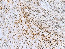 CNOT7 Antibody - Immunohistochemistry of paraffin-embedded Human lung cancer tissue  using CNOT7 Polyclonal Antibody at dilution of 1:55(×200)