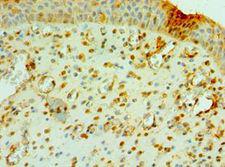 CNOT8 Antibody - Immunohistochemistry of paraffin-embedded human prostate cancer using antibody at 1:100 dilution.