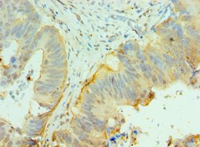 CNOT8 Antibody - Immunohistochemistry of paraffin-embedded human colon cancer using antibody at 1:100 dilution.