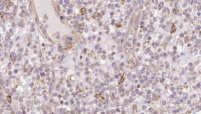 Cnpy2 / TMEM4 Antibody - 1:100 staining human lymph carcinoma tissue by IHC-P. The sample was formaldehyde fixed and a heat mediated antigen retrieval step in citrate buffer was performed. The sample was then blocked and incubated with the antibody for 1.5 hours at 22°C. An HRP conjugated goat anti-rabbit antibody was used as the secondary.