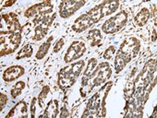 Cnpy2 / TMEM4 Antibody - Immunohistochemistry of paraffin-embedded Human esophagus cancer tissue  using CNPY2 Polyclonal Antibody at dilution of 1:25(×200)