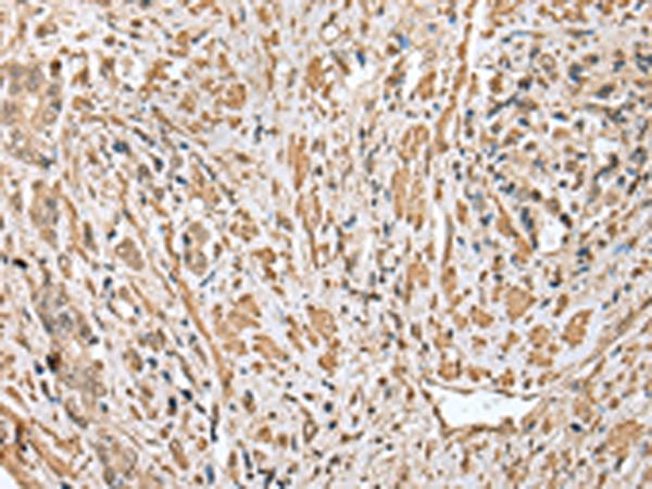 Cnpy2 / TMEM4 Antibody - Immunohistochemistry of paraffin-embedded Human prost ate cancer tissue  using CNPY2 Polyclonal Antibody at dilution of 1:25(×200)