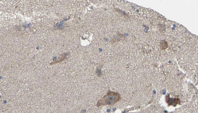 CNR1 / CB1 Antibody - 1:100 staining human brain carcinoma tissue by IHC-P. The sample was formaldehyde fixed and a heat mediated antigen retrieval step in citrate buffer was performed. The sample was then blocked and incubated with the antibody for 1.5 hours at 22°C. An HRP conjugated goat anti-rabbit antibody was used as the secondary.
