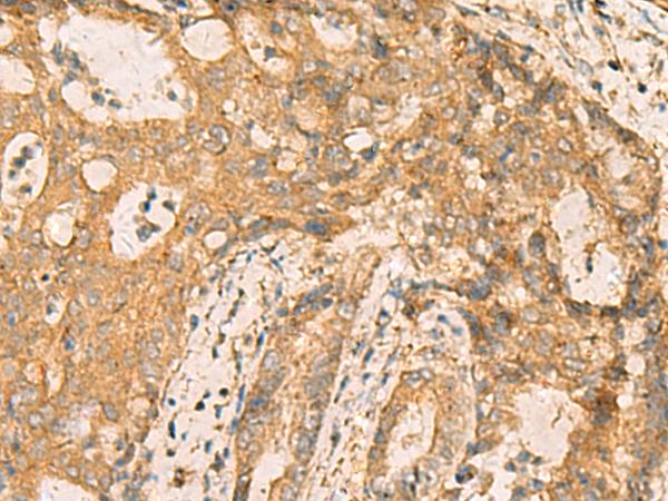 CNST Antibody - Immunohistochemistry of paraffin-embedded Human cervical cancer tissue  using CNST Polyclonal Antibody at dilution of 1:70(×200)