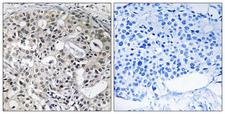 CNTD2 Antibody - Peptide - + Immunohistochemistry analysis of paraffin-embedded human breast carcinoma tissue using CNTD2 antibody.