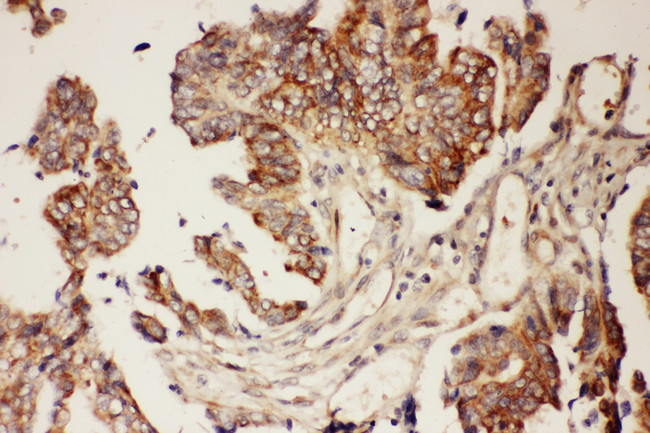 CNTF Antibody - CNTF antibody. IHC(P): Human Intestinal Cancer Tissue.