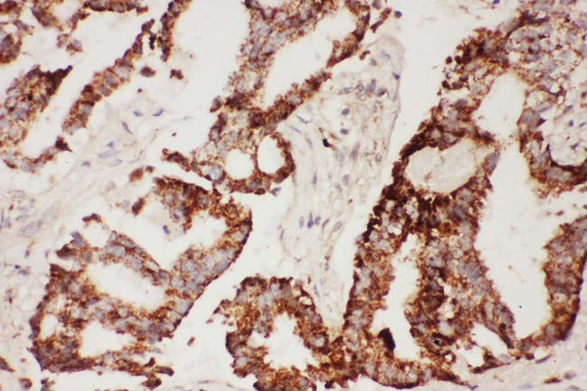 CNTF Antibody - CNTF antibody. IHC(P): Human Lung Cancer Tissue.