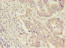 CNTFR Antibody - Immunohistochemistry of paraffin-embedded human colon cancer using antibody at 1:100 dilution.  This image was taken for the unconjugated form of this product. Other forms have not been tested.