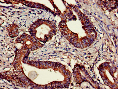 CNTFR Antibody - Immunohistochemistry of paraffin-embedded human colon cancer using CNTFR Antibody at dilution of 1:100