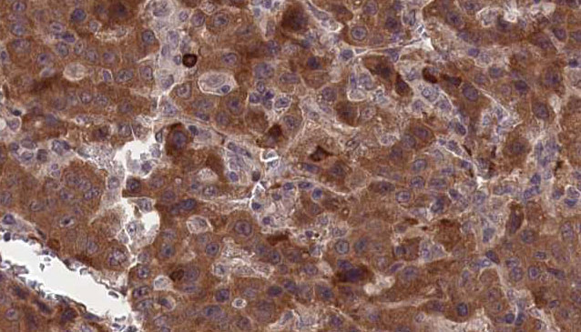 CNTFR Antibody - 1:100 staining human liver carcinoma tissues by IHC-P. The sample was formaldehyde fixed and a heat mediated antigen retrieval step in citrate buffer was performed. The sample was then blocked and incubated with the antibody for 1.5 hours at 22°C. An HRP conjugated goat anti-rabbit antibody was used as the secondary.