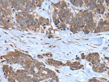 CNTN1 / gp135 / Contactin 1 Antibody - Immunohistochemistry of paraffin-embedded Human thyroid cancer tissue  using CNTN1 Polyclonal Antibody at dilution of 1:35(×200)