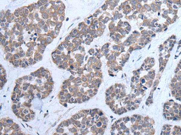 CNTN1 / gp135 / Contactin 1 Antibody - Immunohistochemistry of paraffin-embedded Human esophagus cancer tissue  using CNTN1 Polyclonal Antibody at dilution of 1:35(×200)