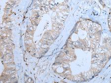 CNTN1 / gp135 / Contactin 1 Antibody - Immunohistochemistry of paraffin-embedded Human colorectal cancer tissue  using CNTN1 Polyclonal Antibody at dilution of 1:55(×200)