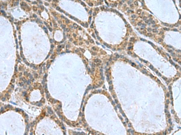 CNTN4 Antibody - Immunohistochemistry of paraffin-embedded Human thyroid cancer tissue  using CNTN4 Polyclonal Antibody at dilution of 1:65(×200)
