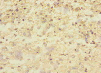 CNTNAP1 / CASPR / p190 Antibody - Immunohistochemistry of paraffin-embedded human glioma at dilution 1:100