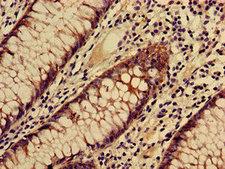 CO-029 / TSPAN8 Antibody - Immunohistochemistry of paraffin-embedded human colon cancer using TSPAN8 Antibody at dilution of 1:100