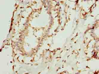 COA1 Antibody - Immunohistochemistry of paraffin-embedded human breast cancer using antibody at dilution of 1:100.