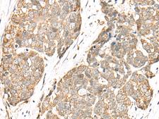 COA7 / SELRC1 Antibody - Immunohistochemistry of paraffin-embedded Human thyroid cancer tissue  using COA7 Polyclonal Antibody at dilution of 1:55(×200)