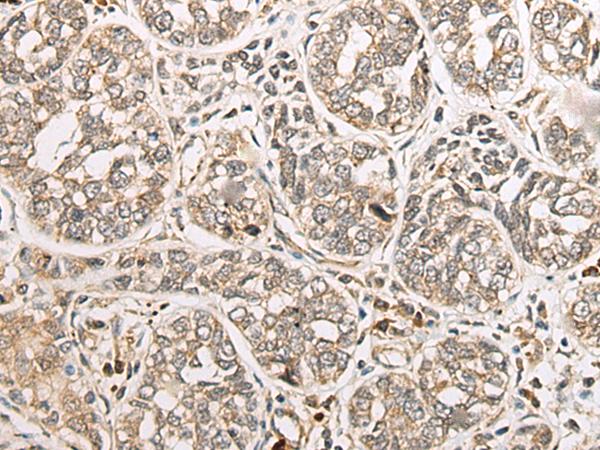 COA7 / SELRC1 Antibody - Immunohistochemistry of paraffin-embedded Human esophagus cancer tissue  using COA7 Polyclonal Antibody at dilution of 1:55(×200)