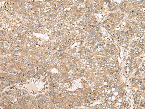 COA7 / SELRC1 Antibody - Immunohistochemistry of paraffin-embedded Human liver cancer tissue  using COA7 Polyclonal Antibody at dilution of 1:55(×200)