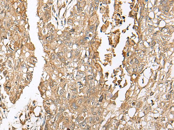 COA7 / SELRC1 Antibody - Immunohistochemistry of paraffin-embedded Human lung cancer tissue  using COA7 Polyclonal Antibody at dilution of 1:55(×200)