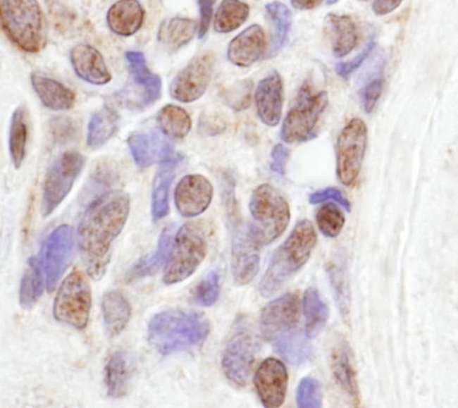 COAA / RBM14 Antibody - Detection of Human CoAA by Immunohistochemistry. Sample: FFPE section of human prostate adenocarcinoma. Antibody: Affinity purified rabbit anti-CoAA used at a dilution of 1:250. Detection: DAB.