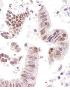 COAA / RBM14 Antibody - Detection of Human CoAA by Immunohistochemistry. Sample: FFPE section of human stomach carcinoma. Antibody: Affinity purified rabbit anti-CoAA used at a dilution of 1:1000 (1 ug/ml).