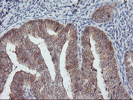 COASY Antibody - IHC of paraffin-embedded Adenocarcinoma of Human endometrium tissue using anti-COASY mouse monoclonal antibody.