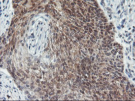 COASY Antibody - IHC of paraffin-embedded Carcinoma of Human bladder tissue using anti-COASY mouse monoclonal antibody.