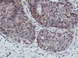 COASY Antibody - IHC of paraffin-embedded Carcinoma of Human lung tissue using anti-COASY mouse monoclonal antibody.