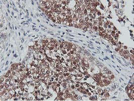 COASY Antibody - IHC of paraffin-embedded Adenocarcinoma of Human ovary tissue using anti-COASY mouse monoclonal antibody.
