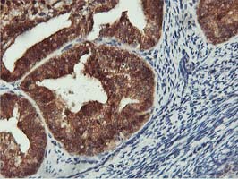 COASY Antibody - IHC of paraffin-embedded Adenocarcinoma of Human endometrium tissue using anti-COASY mouse monoclonal antibody.