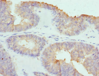 Cochlin / COCH Antibody - Immunohistochemistry of paraffin-embedded Human endometrial cancer at dilution 1:100