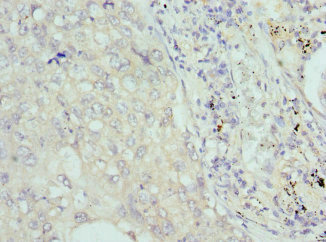 Cochlin / COCH Antibody - Immunohistochemistry of paraffin-embedded Human lung cancer at dilution 1:100