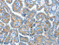 COG1 Antibody - Immunohistochemistry of paraffin-embedded Human lung cancer using COG1 Polyclonal Antibody at dilution of 1:60.
