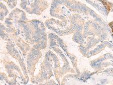 COG4 Antibody - Immunohistochemistry of paraffin-embedded Human thyroid cancer tissue  using COG4 Polyclonal Antibody at dilution of 1:30(×200)