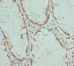 COG5 Antibody - Immunohistochemistry of paraffin-embedded human colon cancer at dilution 1:100