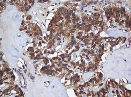 COG6 Antibody - IHC of paraffin-embedded Carcinoma of Human pancreas tissue using anti-COG6 mouse monoclonal antibody. (Heat-induced epitope retrieval by 10mM citric buffer, pH6.0, 120°C for 3min).