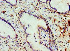 COG7 Antibody - Immunohistochemistry of paraffin-embedded human cervical cancer using antibody at 1:100 dilution.