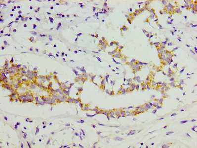 COL11A1 / Collagen XI Alpha 1 Antibody - IHC image of COL2A1 Antibody diluted at 1:300 and staining in paraffin-embedded human breast cancer performed on a Leica BondTM system. After dewaxing and hydration, antigen retrieval was mediated by high pressure in a citrate buffer (pH 6.0). Section was blocked with 10% normal goat serum 30min at RT. Then primary antibody (1% BSA) was incubated at 4°C overnight. The primary is detected by a biotinylated secondary antibody and visualized using an HRP conjugated SP system.