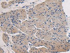 COL17A1 / Collagen XVII Antibody - Immunohistochemistry of paraffin-embedded Human gastric cancer tissue  using COL17A1 Polyclonal Antibody at dilution of 1:50(×200)