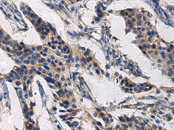 COL17A1 / Collagen XVII Antibody - Immunohistochemistry of paraffin-embedded Human breast cancer tissue  using COL17A1 Polyclonal Antibody at dilution of 1:50(×200)