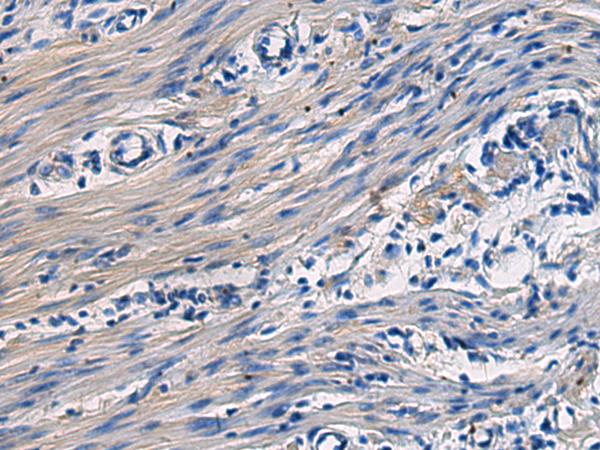 COL17A1 / Collagen XVII Antibody - Immunohistochemistry of paraffin-embedded Human colorectal cancer tissue  using COL17A1 Polyclonal Antibody at dilution of 1:50(×200)