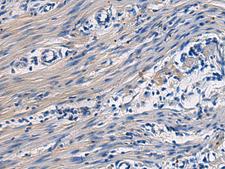 COL17A1 / Collagen XVII Antibody - Immunohistochemistry of paraffin-embedded Human colorectal cancer tissue  using COL17A1 Polyclonal Antibody at dilution of 1:50(×200)