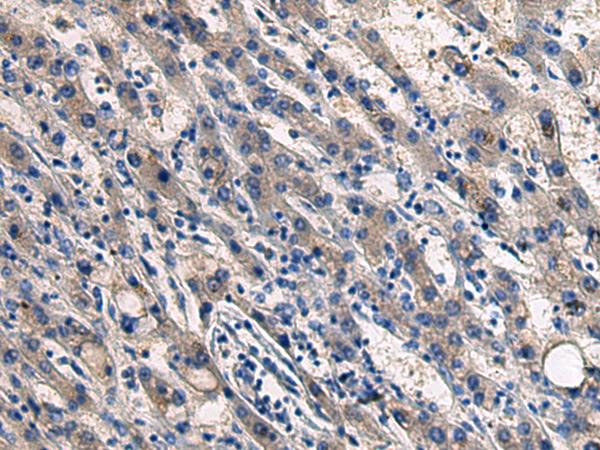COL17A1 / Collagen XVII Antibody - Immunohistochemistry of paraffin-embedded Human liver cancer tissue  using COL17A1 Polyclonal Antibody at dilution of 1:50(×200)