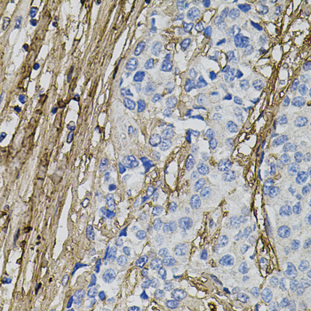 COL1A1 / Collagen I Alpha 1 Antibody - Immunohistochemistry of paraffin-embedded human prostate cancer using COL1A1 antibodyat dilution of 1:100 (40x lens).