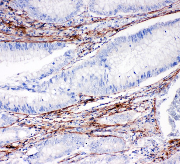 COL1A1 / Collagen I Alpha 1 Antibody - Collagen I antibody IHC-paraffin: Human Intestinal Cancer Tissue.