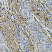 COL1A1 / Collagen I Alpha 1 Antibody - Immunohistochemistry of paraffin-embedded human esophageal cancer using COL1A1 antibodyat dilution of 1:100 (40x lens).