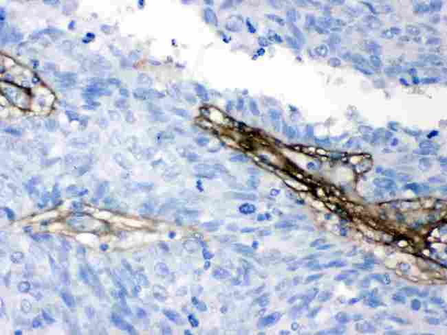 COL1A1 / Collagen I Alpha 1 Antibody - Collagen I was detected in paraffin-embedded sections of human lung cancer tissues using rabbit anti- Collagen I Antigen Affinity purified polyclonal antibody